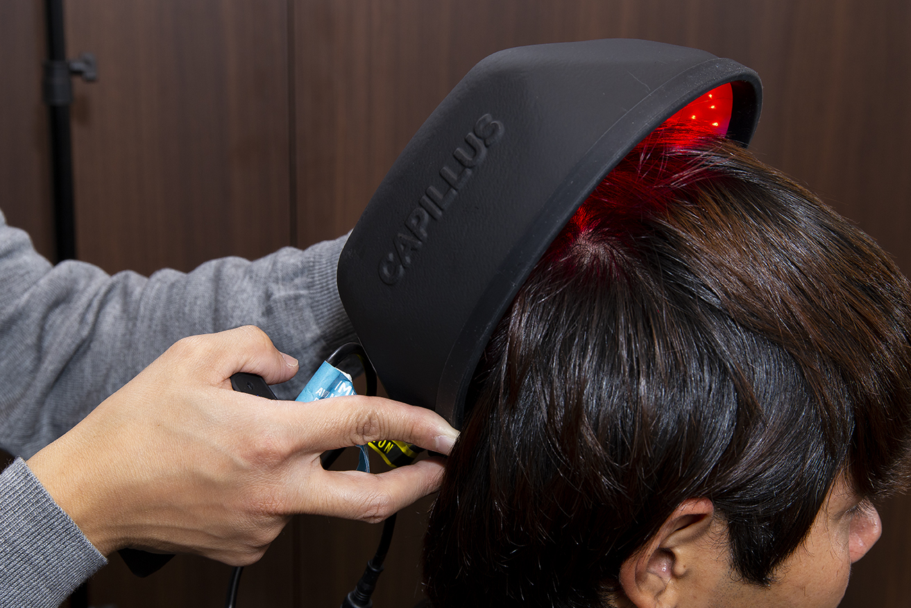 薄毛治療 脱毛症治療ガイドラインで認められた低出力レーザーの効果